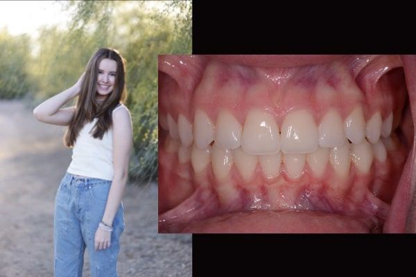 Invisalign before and after case