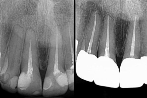 Endodontics Before & After
