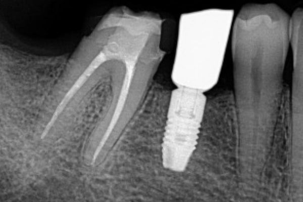 Endodontics After