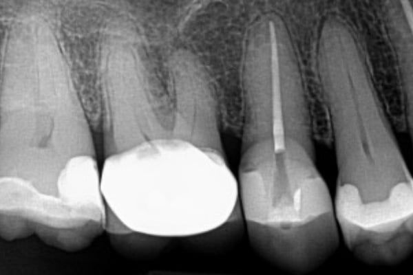 Endodontics Before & After