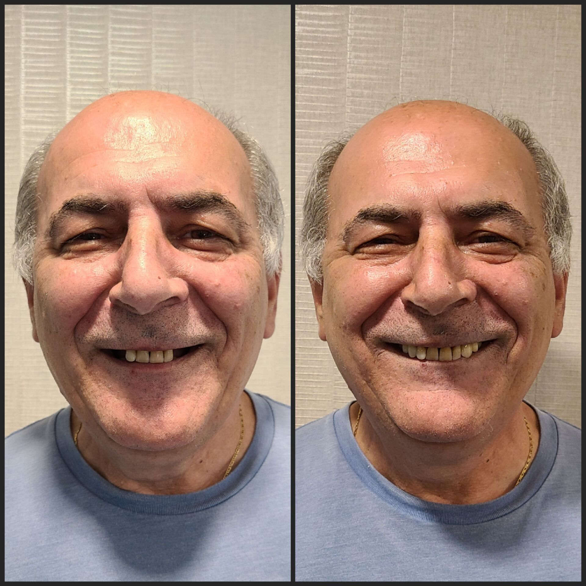 before and after full scope dental implant