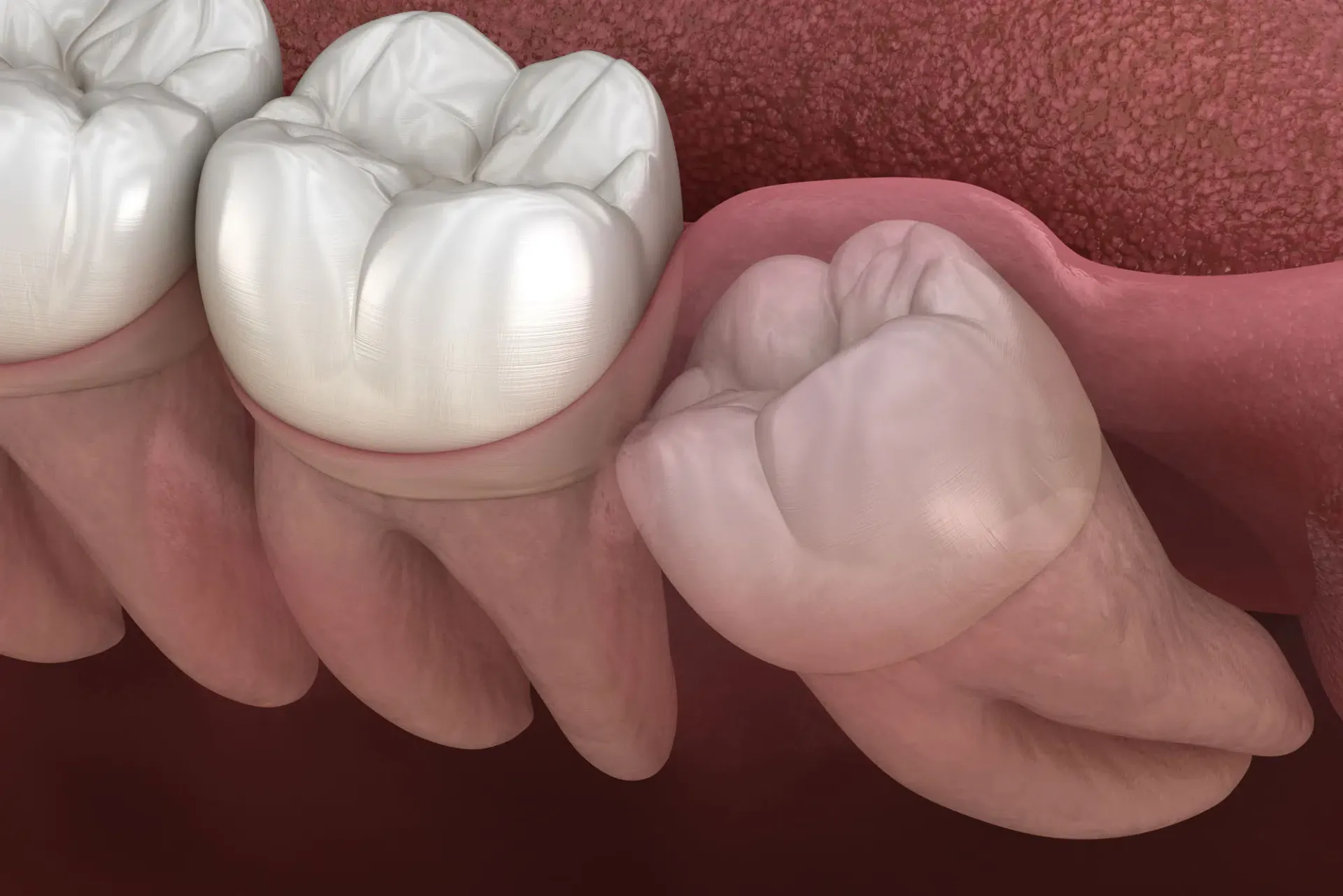 advanced wisdom tooth extraction