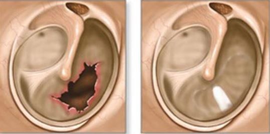 Timpanoplastia: Antes e Depois qual o valor de uma cirurgia de timpanoplastia