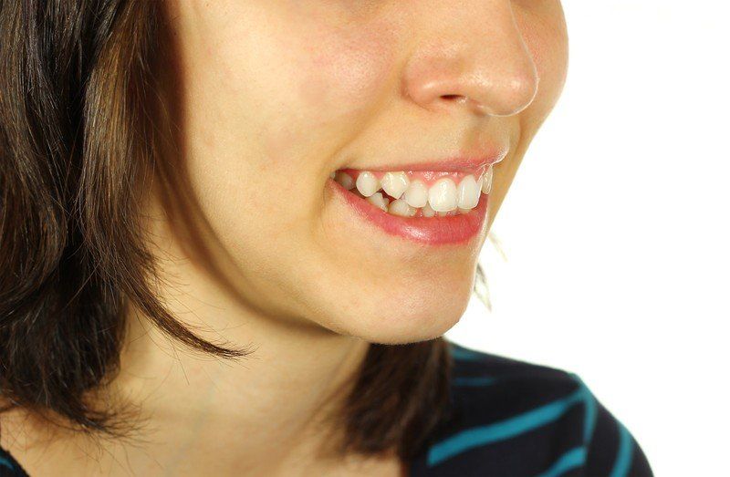 woman with crooked teeth