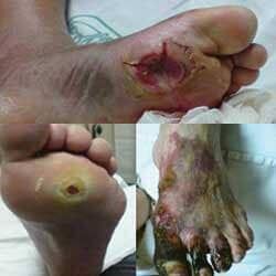 Dr. Tupac Amaru Valle Borboa - CIRUGÍA VASCULAR