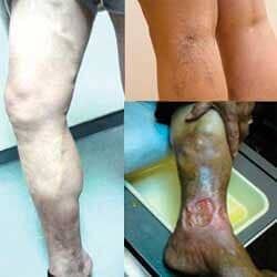 Dr. Tupac Amaru Valle Borboa - ANEURISMAS