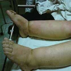 Dr. Tupac Amaru Valle Borboa - EDEMAS