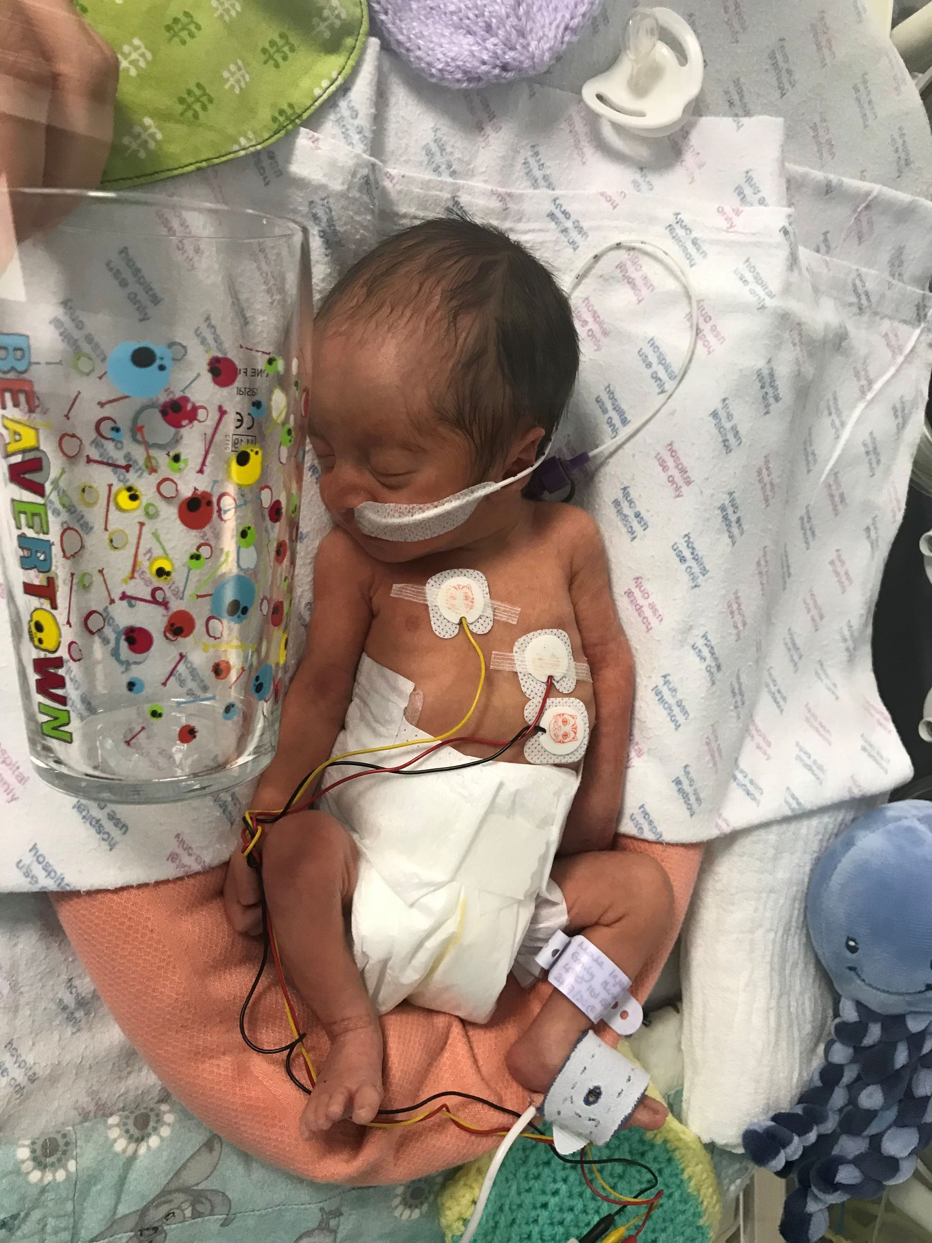 premature baby born at 32 weeks
