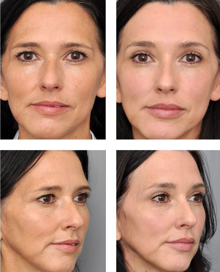 Before and after facial cosmetic procedure: front and side views of a woman, skin smoothed, wrinkles reduced.