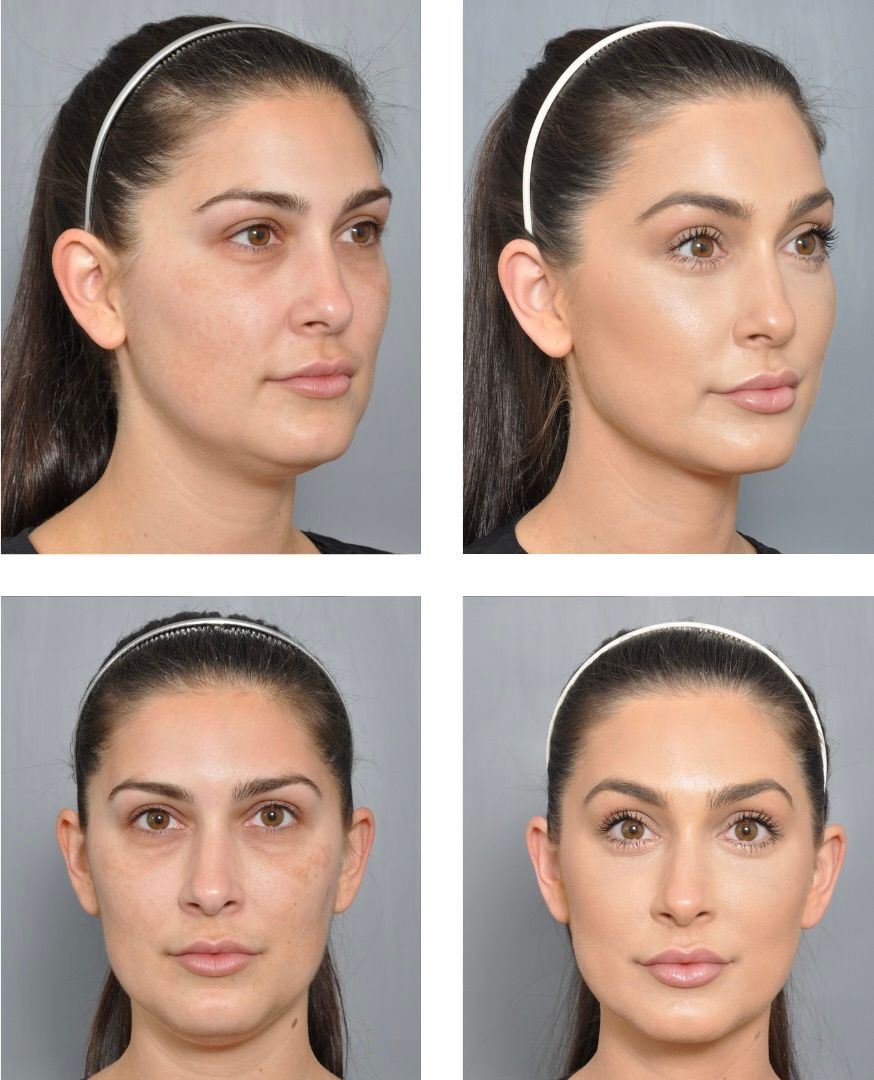 Four-panel comparison. Woman with dark hair, before and after cosmetic procedure. Different angles of her face.