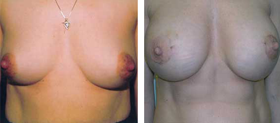 Two sets of breasts, one set smaller and perkier than the other, are side by side.