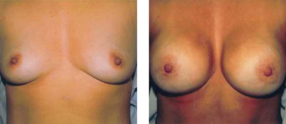 Comparison of two sets of breasts. The breasts on the right appear larger.