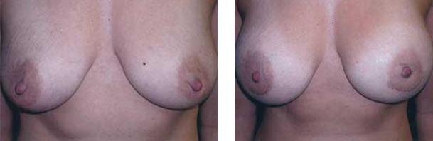 Before and after view of breasts.