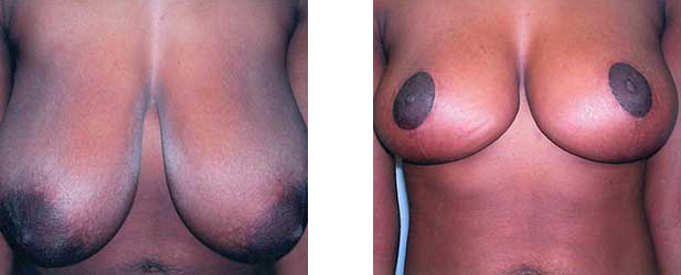 Two sets of breasts, one with darker discoloration.