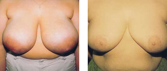 Two breasts side-by-side, before and after surgery.
