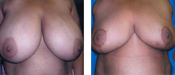 Two views of a woman's breasts, before and after a procedure.