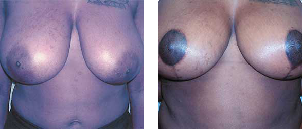 Breasts: one set has light skin and the other has dark skin, both with dark nipples.