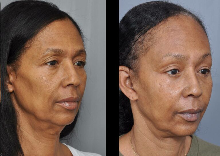 Before and after facial surgery. A woman's face, showing tightened skin, less sagging.