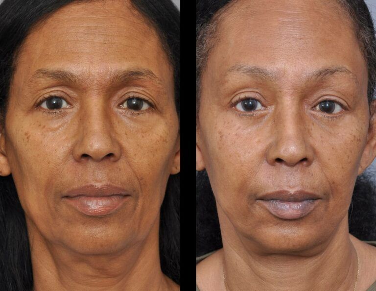 Before and after view of a face, showing reduced wrinkles and smoother skin.
