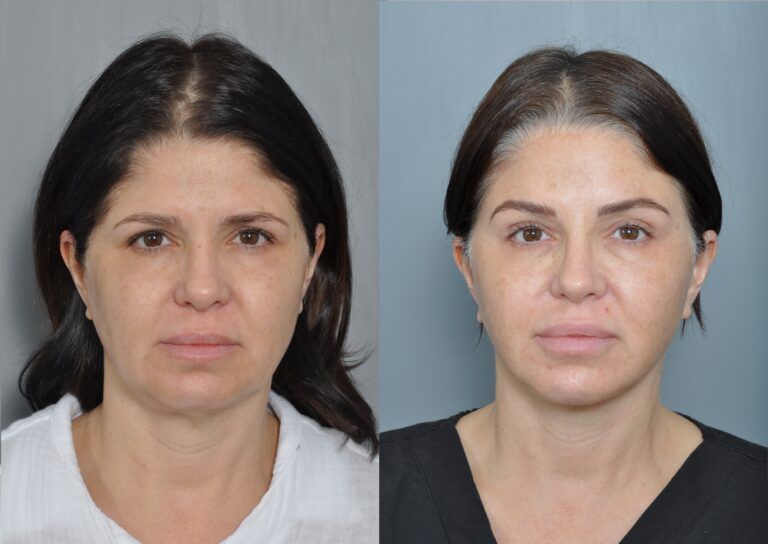 Before-and-after facial comparison. Woman's face shows reduced wrinkles and enhanced features after procedure.