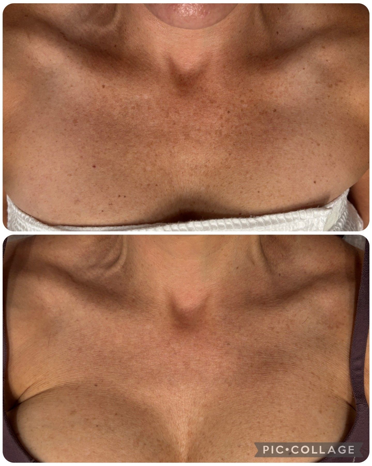 Bye Bye Brown Spots ? IPL Pigment Reduction from Williamson Cosmetic Center in Louisiana