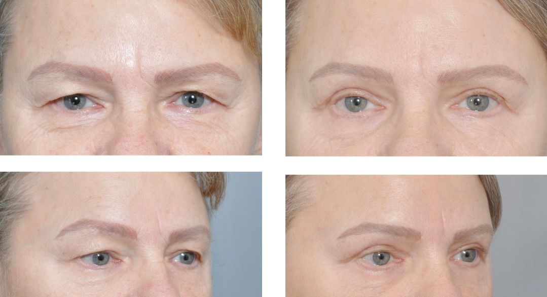 Before and after view of a person's eyes after eyelid surgery. Eyes appear less droopy after the procedure.
