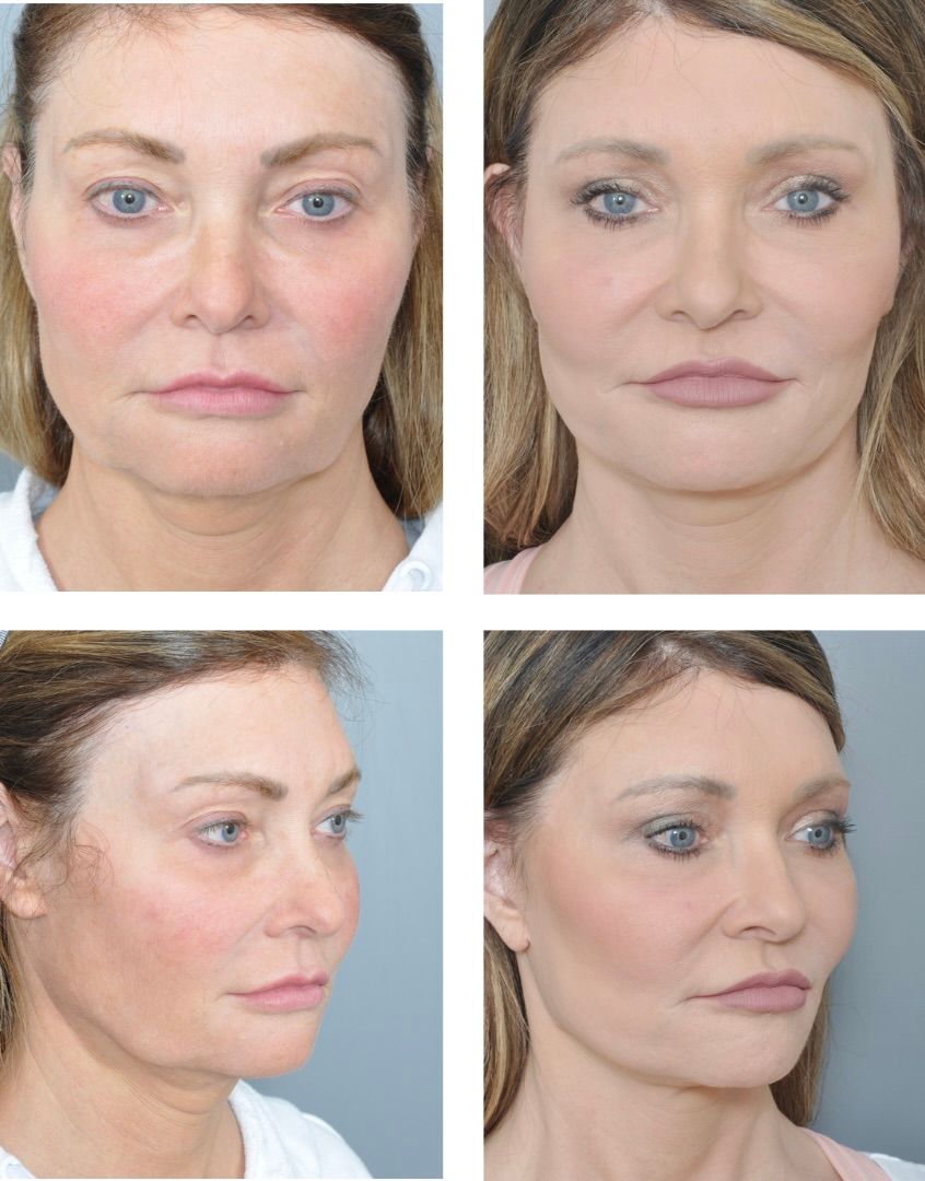 Four-panel comparison: Face before and after cosmetic procedure. Front and profile views show lifted skin, reduced jowls, and smoother texture.