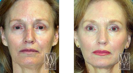 Facial rejuvenation before and after. Woman's face on the left looks older, right side has makeup and smoother skin.