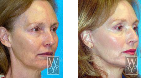 Before and after of a woman's face, showing facelift results.