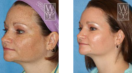 Before-and-after photos of a woman's face, showing a reduction in skin discoloration after treatment.