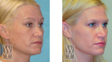 Before and after photos of a woman's face, showing skin rejuvenation.