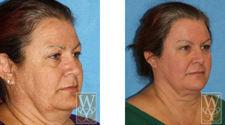 Before and after photos showing a person's facial rejuvenation from surgery. Wrinkles reduced, skin smoother.