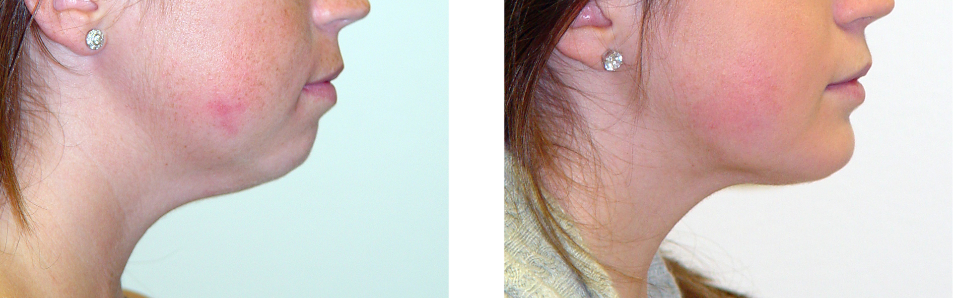 Before and after photos showing a person's profile, the 