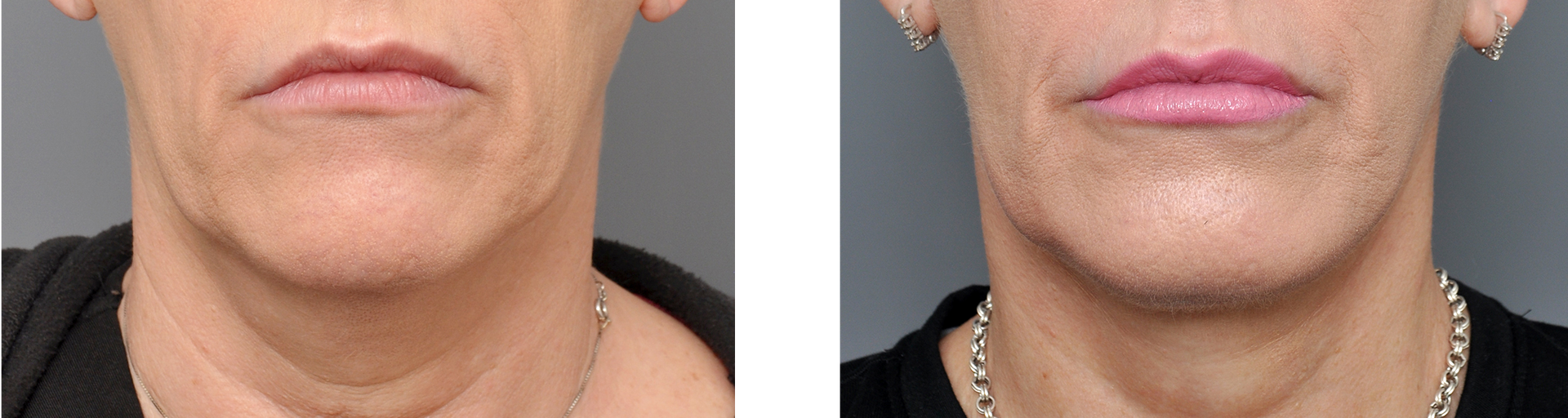 Side-by-side comparison of a person's lower face and neck, before and after a procedure. The after has fuller lips.