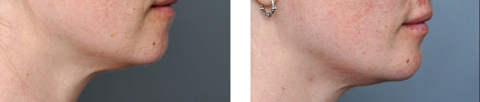 Side-by-side comparison of a person's jawline before and after treatment, showing a reduction of a double chin.