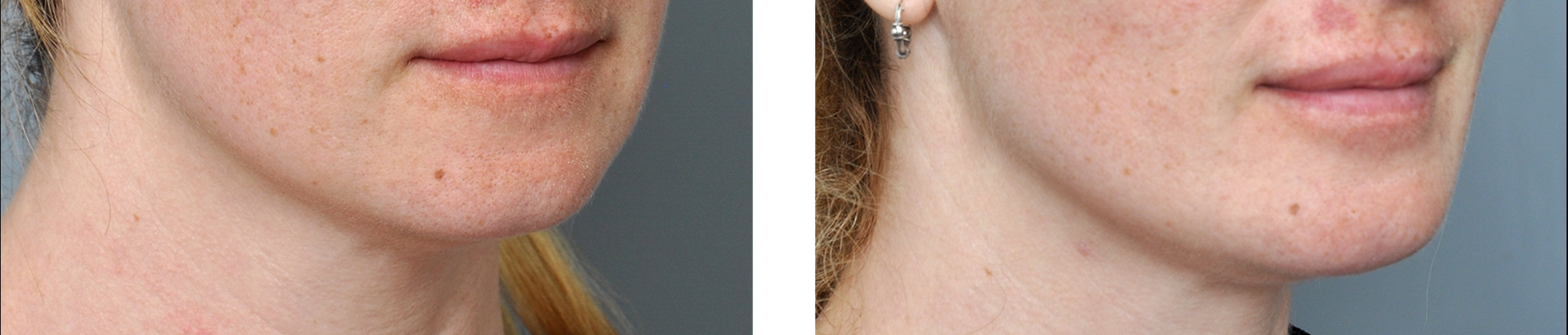 Before-and-after photos of a person's jawline and lips. The 