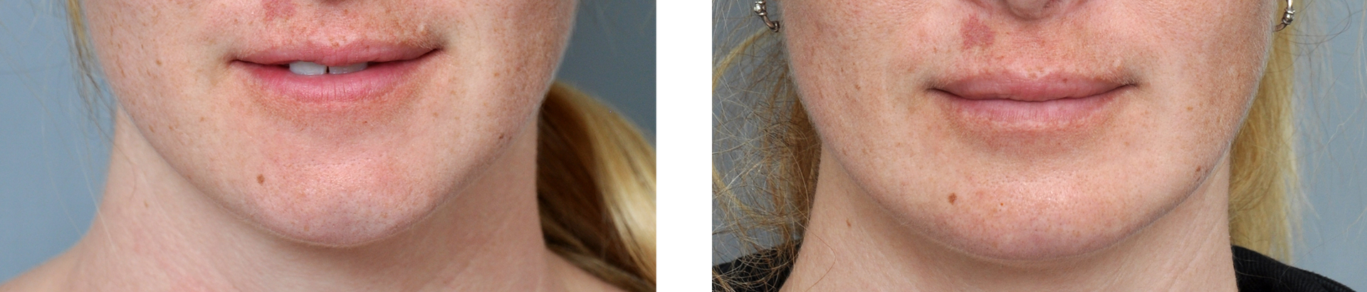 Two close-up photos of a person's mouth and chin. The photo on the right appears to have had skin improvements.