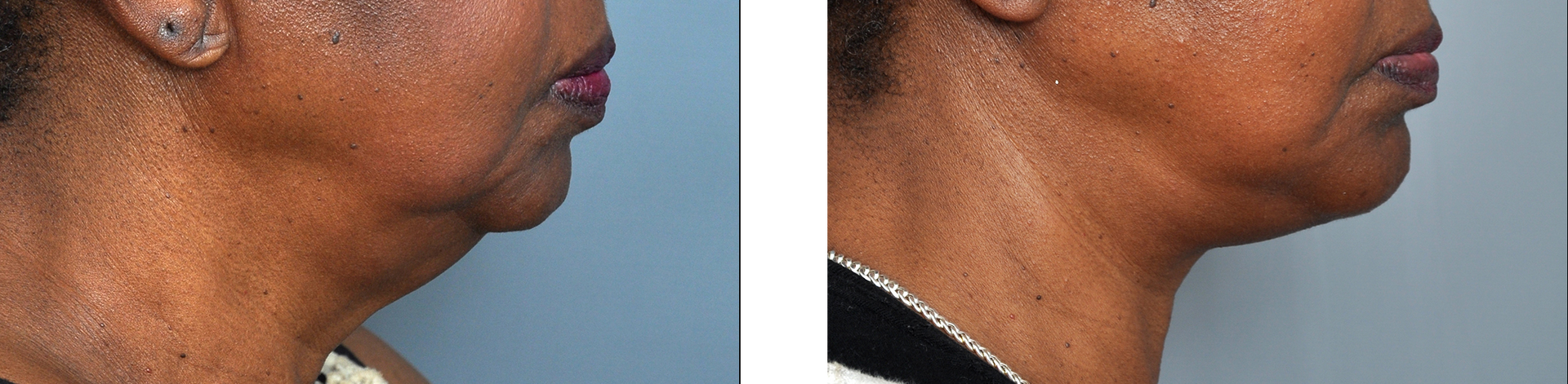 Side-by-side comparison of a person's neck and chin, before and after a cosmetic procedure.