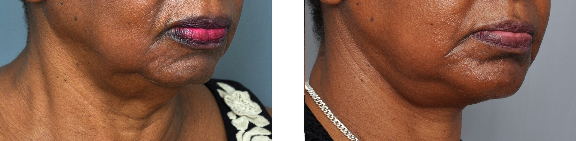 Two side-by-side images showing a person's chin and neck. One image shows more wrinkles than the other.