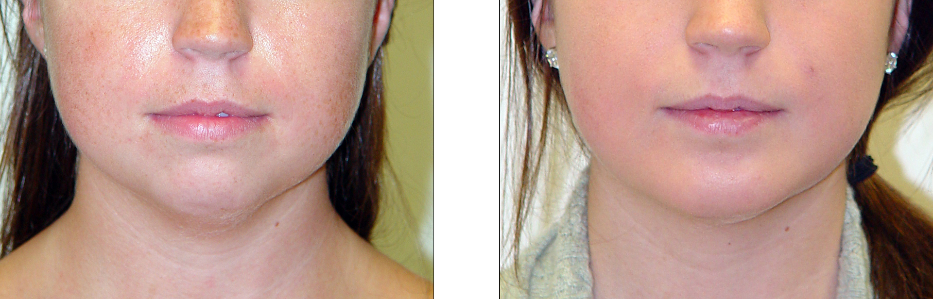 Before and after photos of a person's face; reduced fullness in the jawline after a cosmetic procedure.