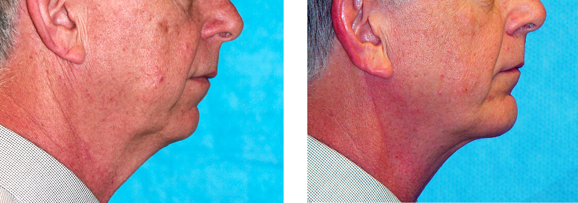 Side-by-side comparison of a man's neck before and after a cosmetic procedure. The skin appears smoother and tighter in the 
