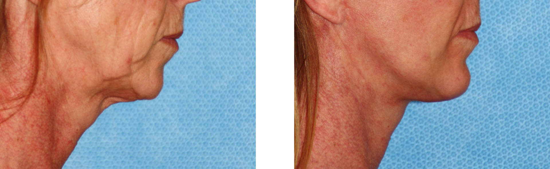 Side-by-side comparison of a neck before and after a cosmetic procedure, showing a reduction in wrinkles and sagging.
