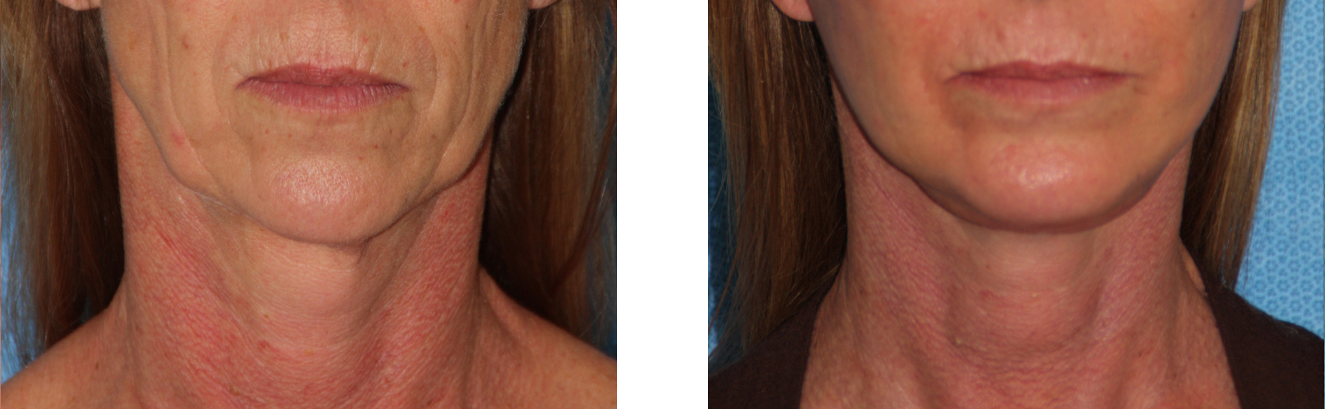 Comparison of a woman's neck before and after a cosmetic procedure. The after photo shows smoother skin.
