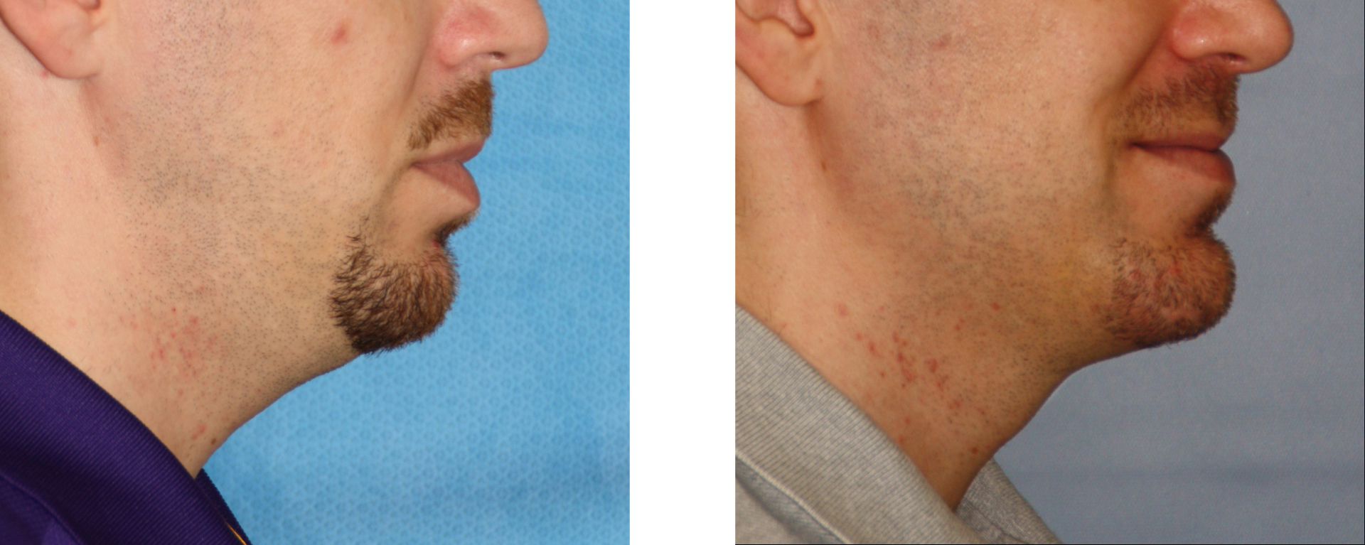 Two side-profile views of a man's face and neck, before and after a cosmetic procedure, showing a change in the jawline.