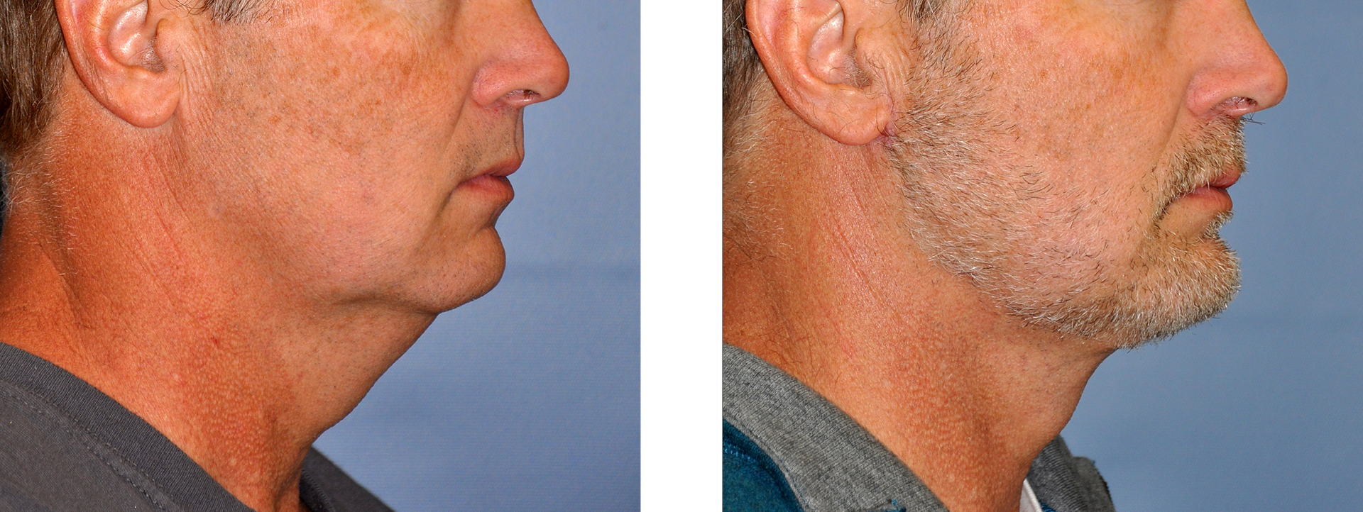 Side-by-side comparison of a man's neck before and after a cosmetic procedure. The 
