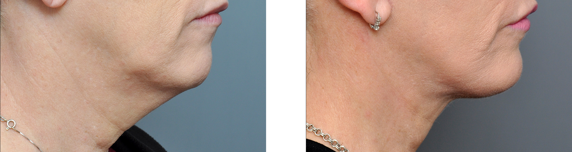 Before and after chin and neck lift comparison, showing reduced sagging.