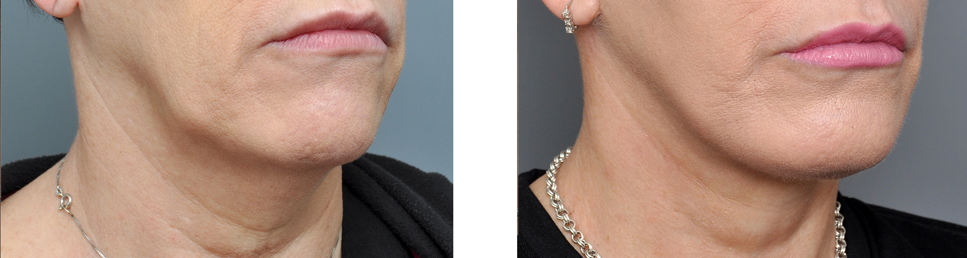 Side-by-side comparison of a person's lower face and neck, before and after a cosmetic procedure.