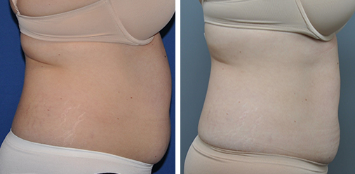 Comparison of a woman's abdomen before and after a surgical procedure, showing a reduction in fat and skin.