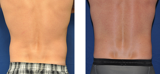 Two views of a person's back. The left shows a back in plaid shorts. The right shows the same back with athletic underwear.