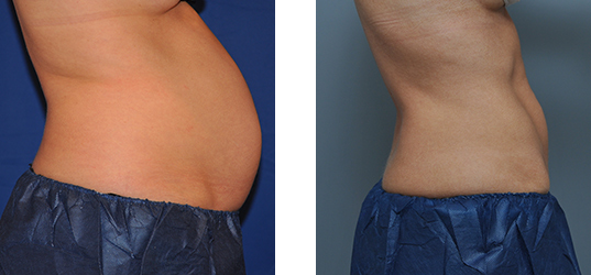 Before-and-after of a person's abdomen. The left shows a fuller abdomen, and the right shows a flatter one.